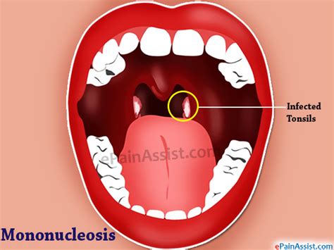 mononucleosis throat mono symptoms warning signs  mononucleosis