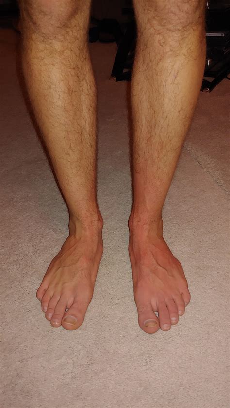 My (I think) dysautonomia : r/covidlonghaulers