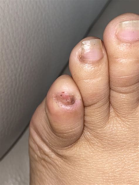 Worried about this dark line in my small toenail. I can’t see a