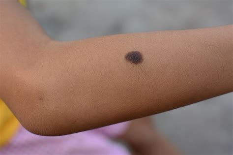 menghilangkan tompel  efektif alodokter