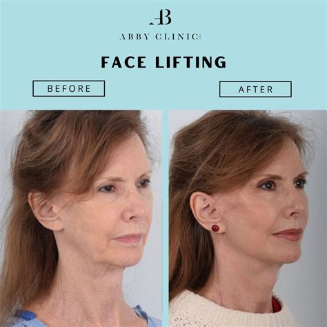 face lifting   reviewed aesthetic clinic  malaysia
