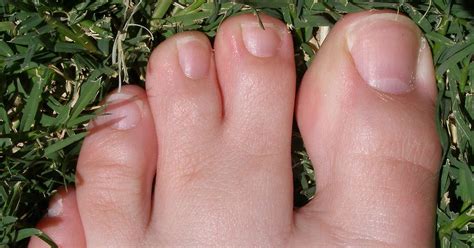 Conditions Associated With Webbed Hands & Feet - HealthPrep.com