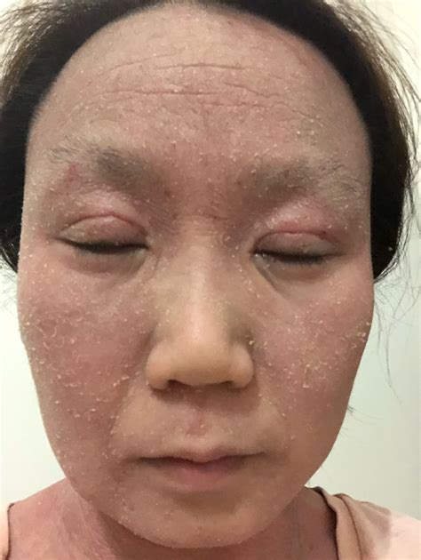 Do Steroids Help Skin Heal at Carlo Simmons blog