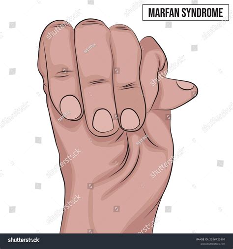 3+ Hundred Marfan Syndrome Royalty-Free Images, Stock Photos & Pictures
