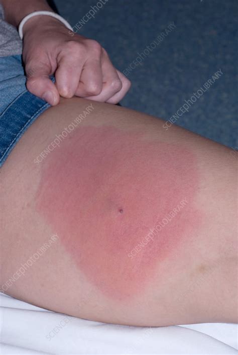 Staph Infection on Leg - Stock Image - C012/3873 - Science Photo Library