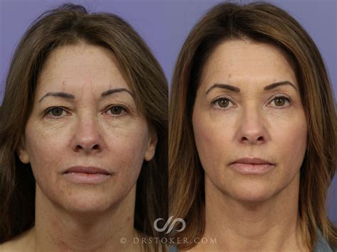 Laser Skin Resurfacing for Los Angeles & Marina Del Rey | Stoker Aesthetics