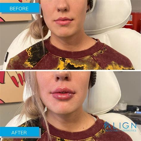 Before and After Lip Injections at Align Injectable Aesthetics