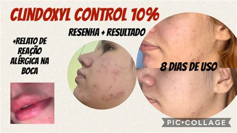 Clindoxyl Gel Antes E Depois