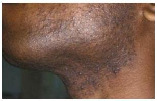 folliculitis barbae current health advice health blog articles  tips