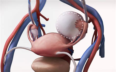 Abdominal myomectomy through Maylard incision - TVASurg - The Toronto ...