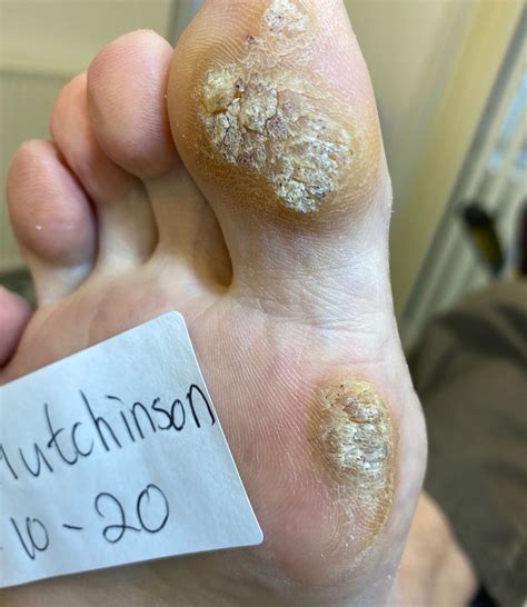 Verruca Plantaris Treatment