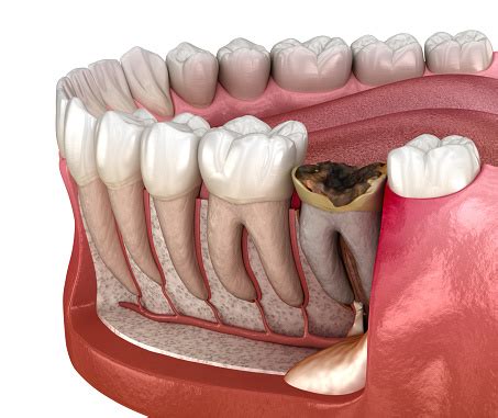 Caroço Na Gengiva Fotos - Foto de Dente De Periostite Caroço Na Gengiva Acima Do Dente Ilustração ...