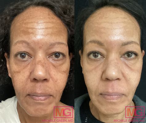 post inflammatory hyperpigmentation treatment options dr michele