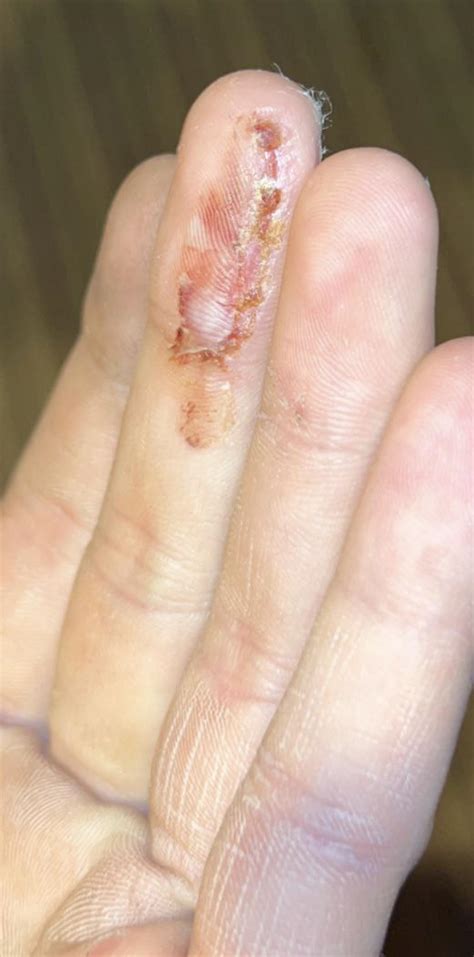 Finger after injury with electric planer which took it down to the bone