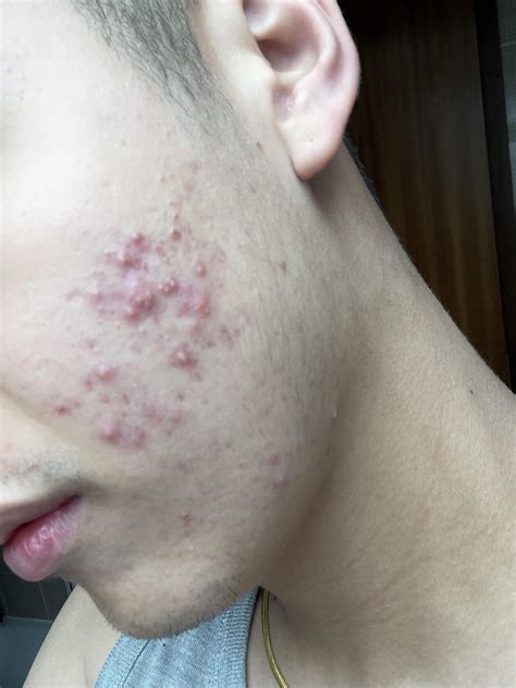 [Acne] Cystic acne? I have panoxyl 10% face wash and Benzaknen Wash 5%