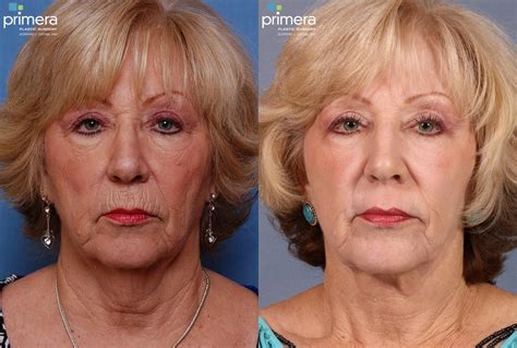 face lift diagram  dennis raleigh blog