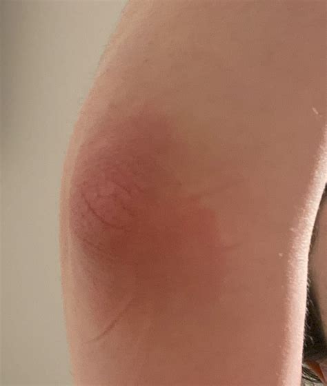 Mysterious rashes with systemic symptoms :( : r/DermatologyQuestions