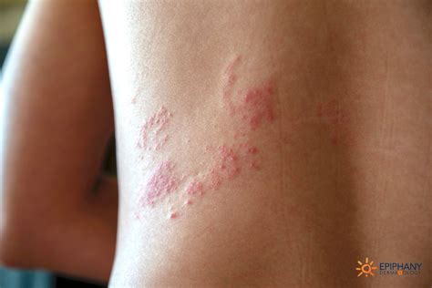 shingles airborne contagious