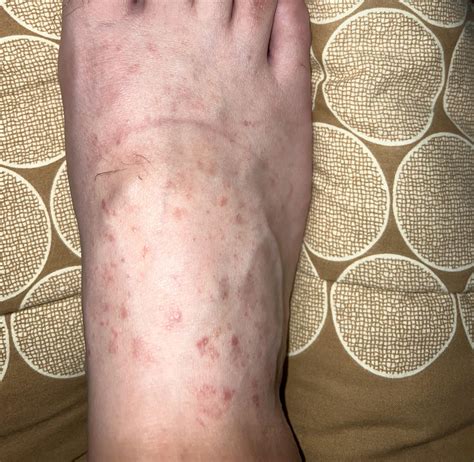 Derma diagnosed this as pityriasis rosea. Concerned that it could be