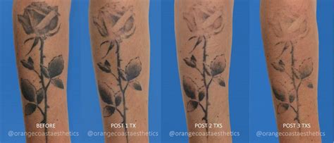 Frequently Asked Questions about Laser Tattoo Removal - Orange Coast ...