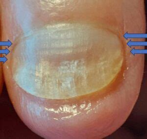 beaus lines nailknowledge