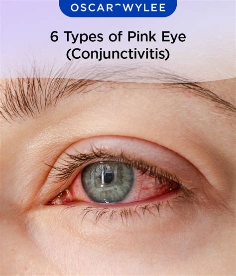 pink eye school school activities