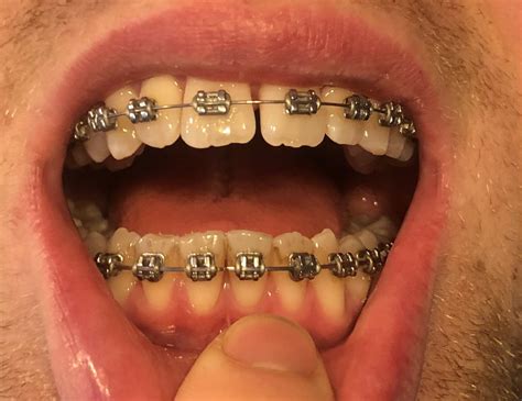 healthy bottom teeth raskdentists