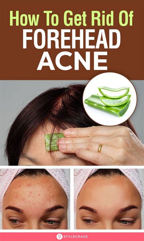 How to get rid of forehead acne 9 home remedies to try – Artofit