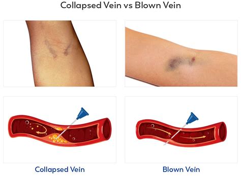 What is a collapsed vein?