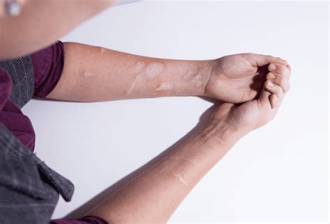 ¿Qué es el Cutting? Autolesiones en adolescentes - Psicólogos en Rancagua 