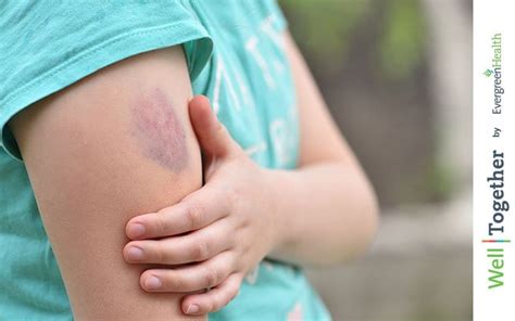 Do You Bruise Easy? Here's What It Could Mean | EvergreenHealth