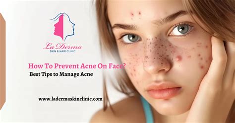 prevent acne  face  tips  manage acne la derma skin