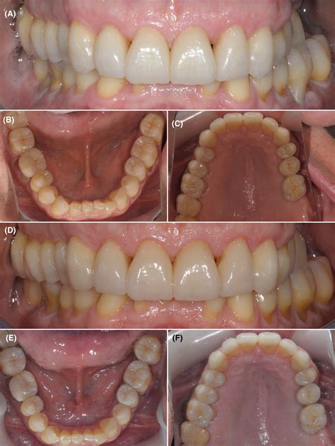 What Are Occlusal Stops at Anthony Bohnsack blog