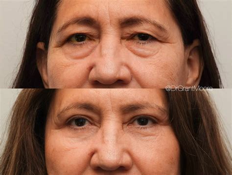 Ophthalmic Plastic Surgery Gallery | Barnet Dulaney Perkins AZ