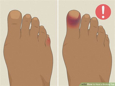 heal  broken toe  steps  pictures wikihow