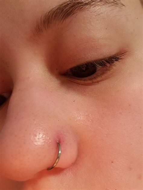 Staph Infection Nose How Scalded Skin Syndrome Works | HowStuffWorks