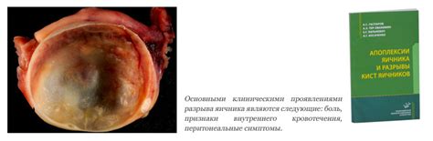Апоплексия яичника (разрыв яичника)
