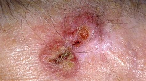 cancerous scalp lesions
