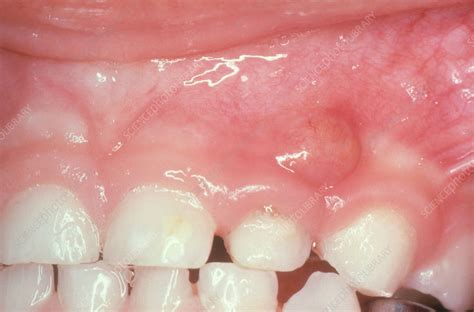 Gum Boil