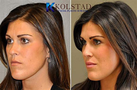 la-jolla-del-mar-lip-fillers-nonsurgical-augmentation-best-filler ...