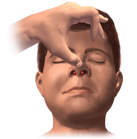 Nasal septal hematoma - Wikiwand