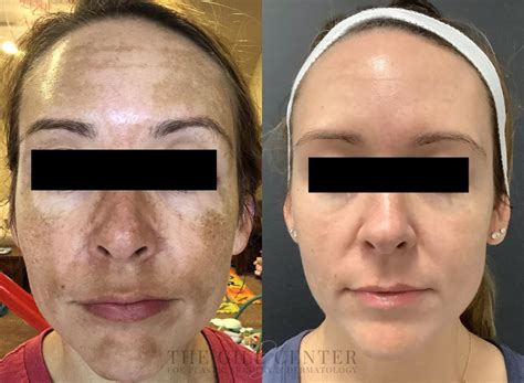 tca peel guide benefits basics