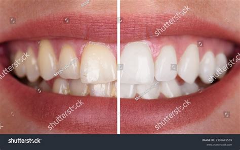 Before After Teeth Cleaning Stock Photo 2398645559 | Shutterstock