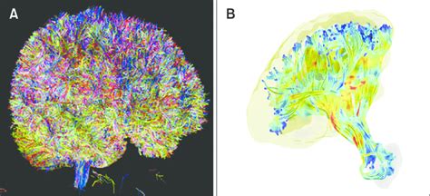 White matter fiber reconstruction using diffusion tensor imaging. Whole ...