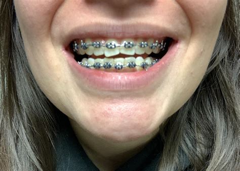 Braces coming off in 3 weeks! : r/braces