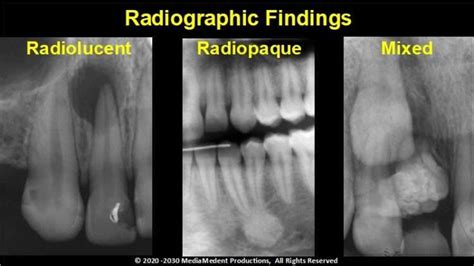 acclaimed lectures  radiolucent radiopaque lesions   jaws