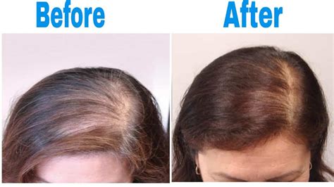 Best Hair Treatments for Hair Loss: A Comprehensive Guide