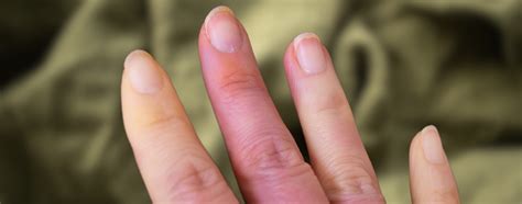 Pontas Dos Dedos Roxas - Síndrome de Raynaud, a doença que afeta as pontas dos dedos