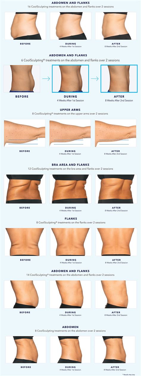 CoolSculpting Elite Before and After | New Treatment + Better Results