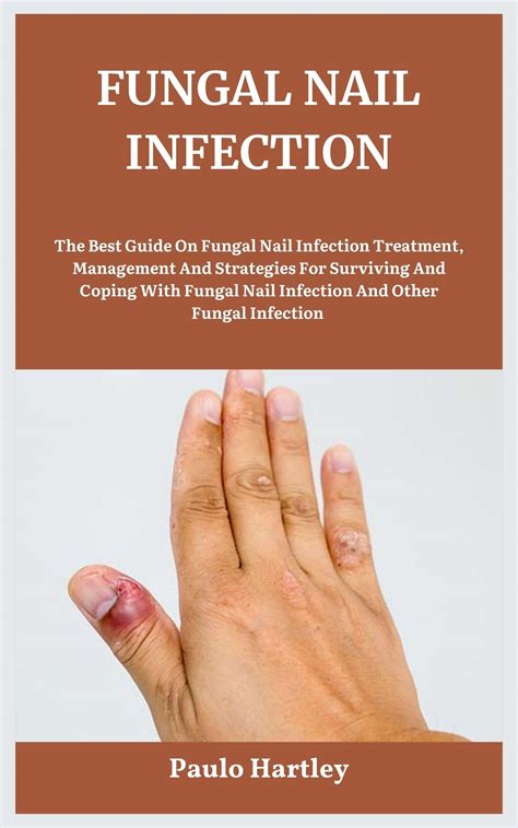 FUNGAL NAIL INFECTION: The Best Guide On Fungal Nail Infection ...